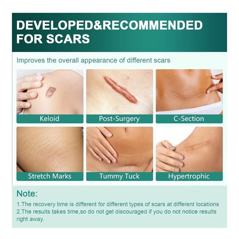 Airroye 1 Roll Silicone Adhesive Scar Sheets 1.6" x 120