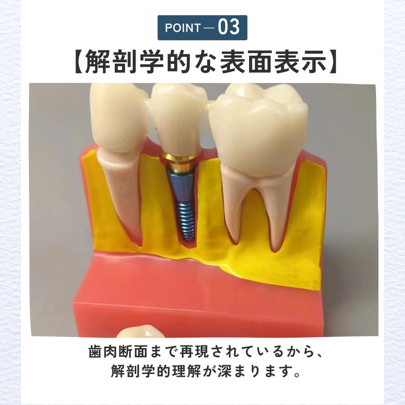 ideamall Implant Model Teeth Course Practice Model Educational Compact