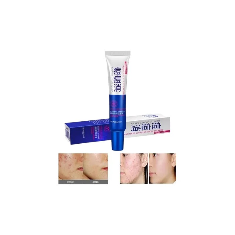 Crema Anti Acn Bioaqua Zona Localizada Piel Grasa Puntos