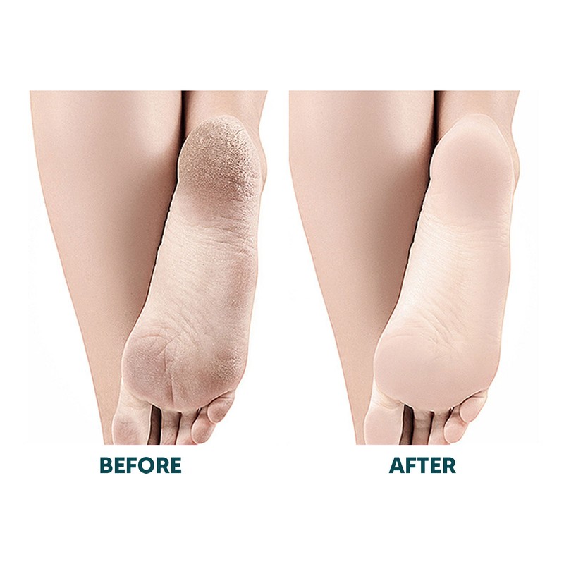 Electric Foot Callus Remover Automatic Safety Lock Multi Functional Rechargeable
