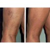 Vitamin K Cream - Eliminate Spider Varicose Veins Rosacea Capillaries