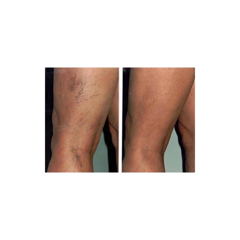 Vitamin K Cream - Eliminate Spider Varicose Veins Rosacea Capillaries