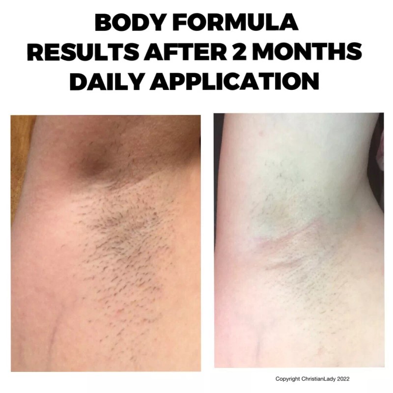 Electrologists Formula Permanent Hair Reduction At Home-Professio