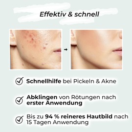 VIGOROUS Zinc Ointment Against Pimples 60 ml - Anti Pimple Cream Also for Pimples on the Butt and Back - with Tea Tree Oil & Salicylic Acid - SOS Zinc Ointment Against Blackheads and Blemished Skin - Pull Ointment Pimples - Acne Cream