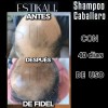 Shampoo Anticaída Anticaspa Antigraso Crecimiento De Cabello