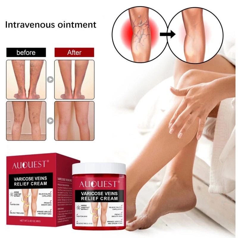 Varicose Veins Relief