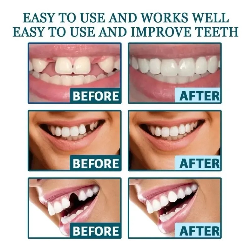 1 Par Carillas Postiza Restauradora Dientes Postizos Sonrisa
