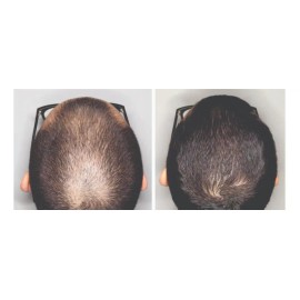 Pharma Group Lab Tratamiento Anticaída De Cabello Al 15% Dth Blocker 6 Meses