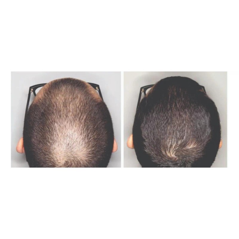 Pharma Group Lab Tratamiento Anticaída De Cabello Al 15% Dth