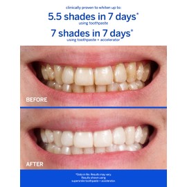 Supersmile Professional Whitening Accelerator - Powerful Whitening without Sensitivity - Safe and Effective on Dental Restorations (3.6 Oz)