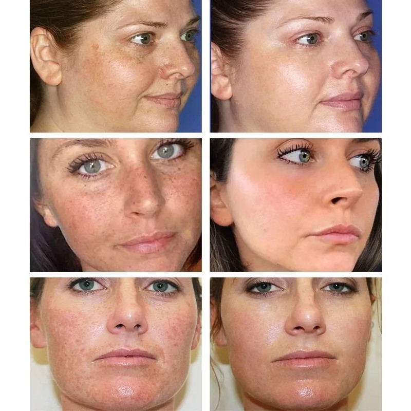 Crema Quitamanchas Hidratante 20g Para Rostro Todo Tipo De Piel