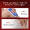 Varicose Veins Relief