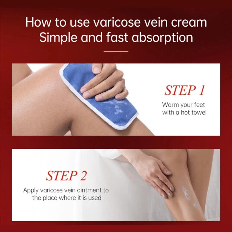 Varicose Veins Relief