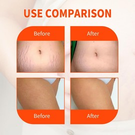 125ml Stretch Mark Oil for Pregnant Women & Post-Surgery Scar Cream | Reduces & Fades Scars & Stretch Marks | Moisturizes & Nourishes Skin | Dermatologist Recommended