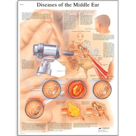 3B Scientific VR1252UU Glossy Paper Diseases of The Middle Ear Anatomical Chart, Poster Size 20" Width x 26" Height