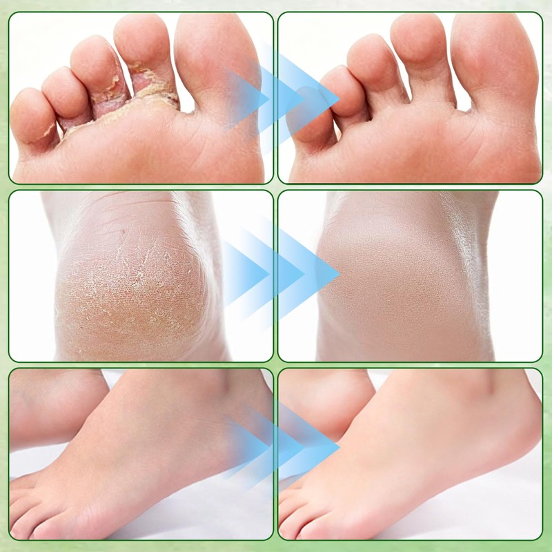NUOKOU 2PCS Tea Tree Oil Foot Cream,with Vitamin E, Aloe