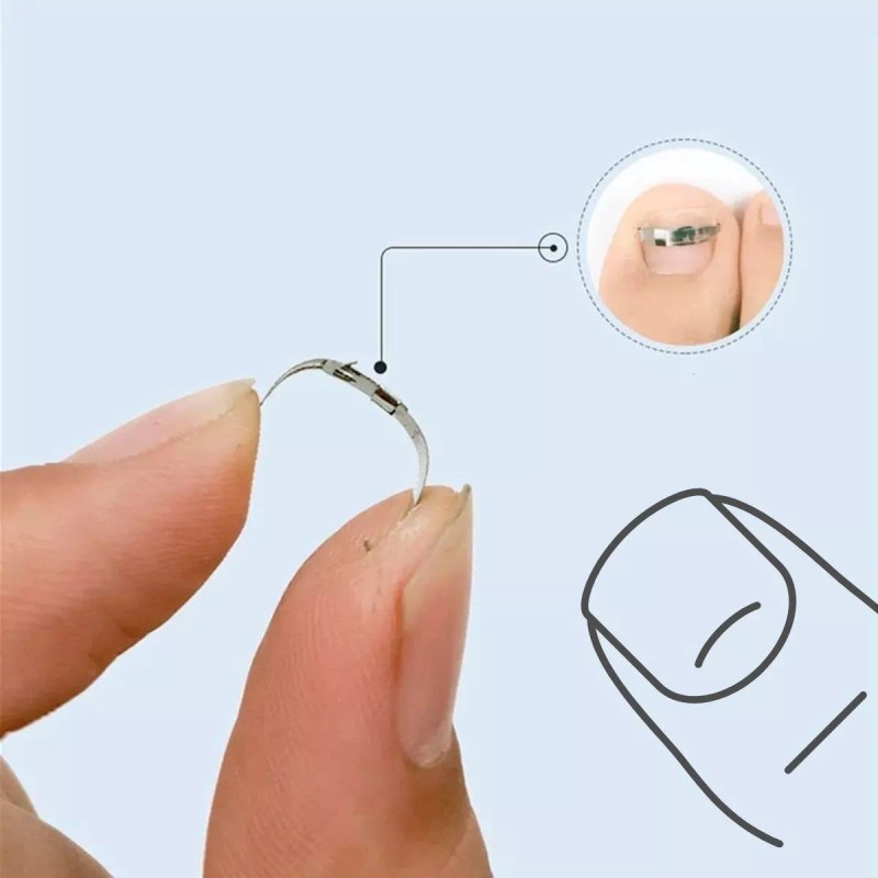 Universo en Linea Herramientas Corrección De Uñas Encarnadas Alivia Dolor