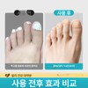 BINEL 발톱무좀밴드 문제성 손발톱 네일 집중케어 BINEL Nail Fungal Infection