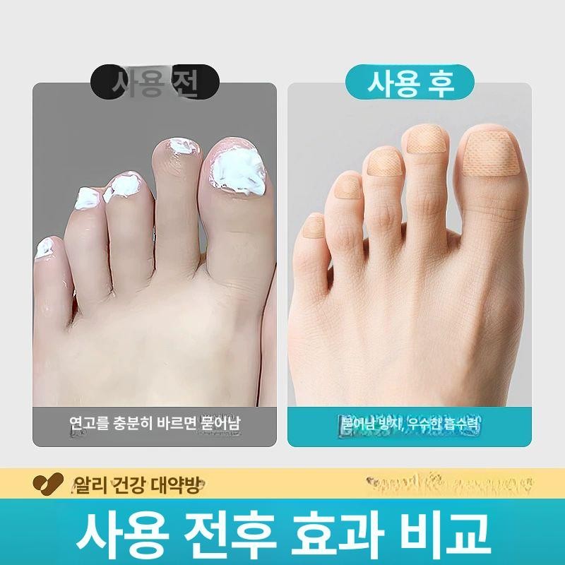 BINEL 발톱무좀밴드 문제성 손발톱 네일 집중케어 BINEL Nail Fungal Infection