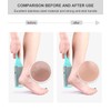 Clyhon Callus File Callus Remover Quick Callus Rasp Foot Care