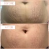 B-flat Crema Reafirmante Para Estras De Celulitis, Tratamien