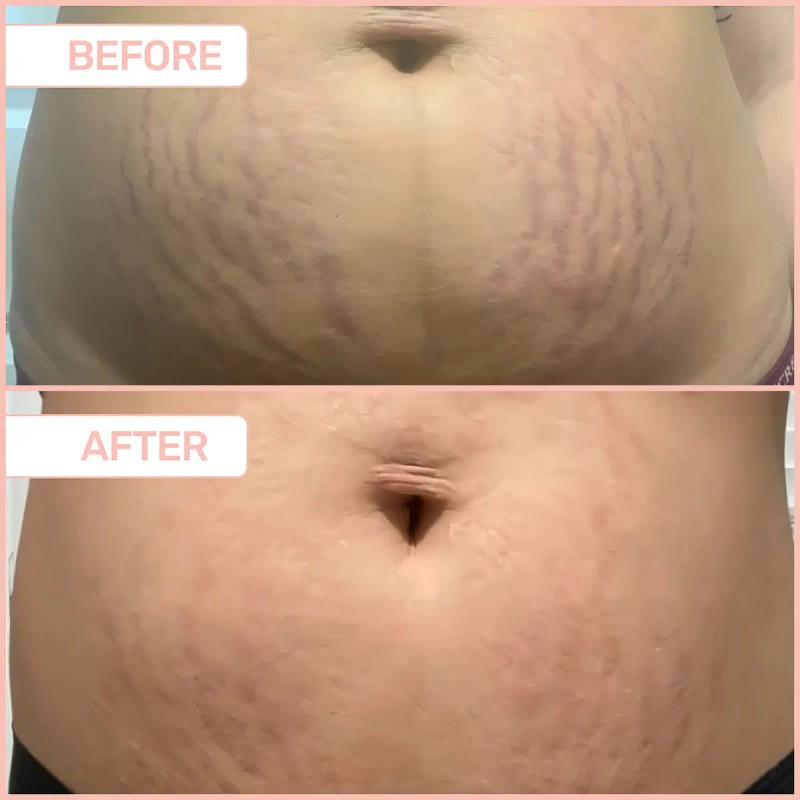 B-flat Crema Reafirmante Para Estras De Celulitis, Tratamien