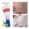 Bioaqua crema antiacné controla grasa y manchas, uso diario facial