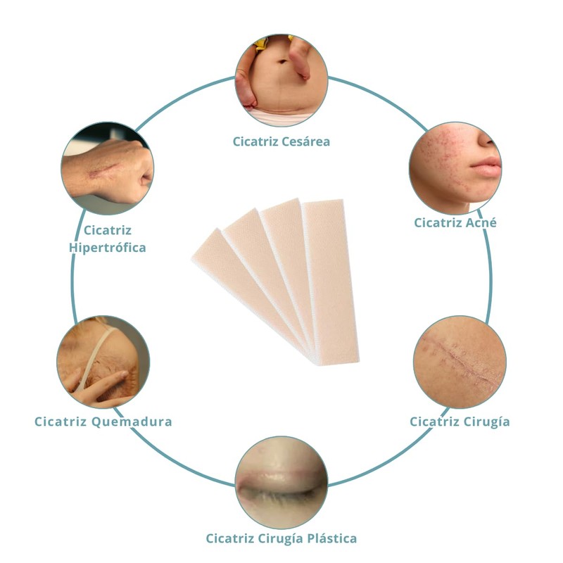 UNIVERSOENLÍNEA.COM | 5 Parches de Silicona para Cicatrices – Suaviza