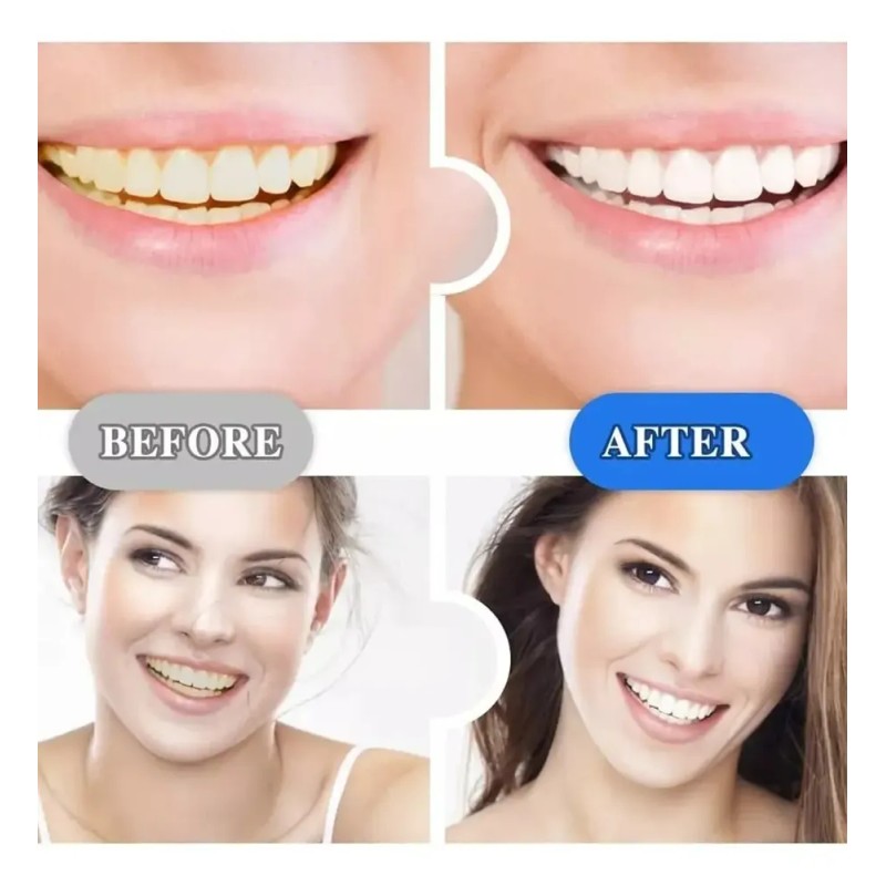 21 Piezas Tiras Bandas Blanqueadoras Tratamiento Dental 5d