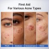 T; Loción Acne Buster, Ácido Salicílico Para El Acné Y