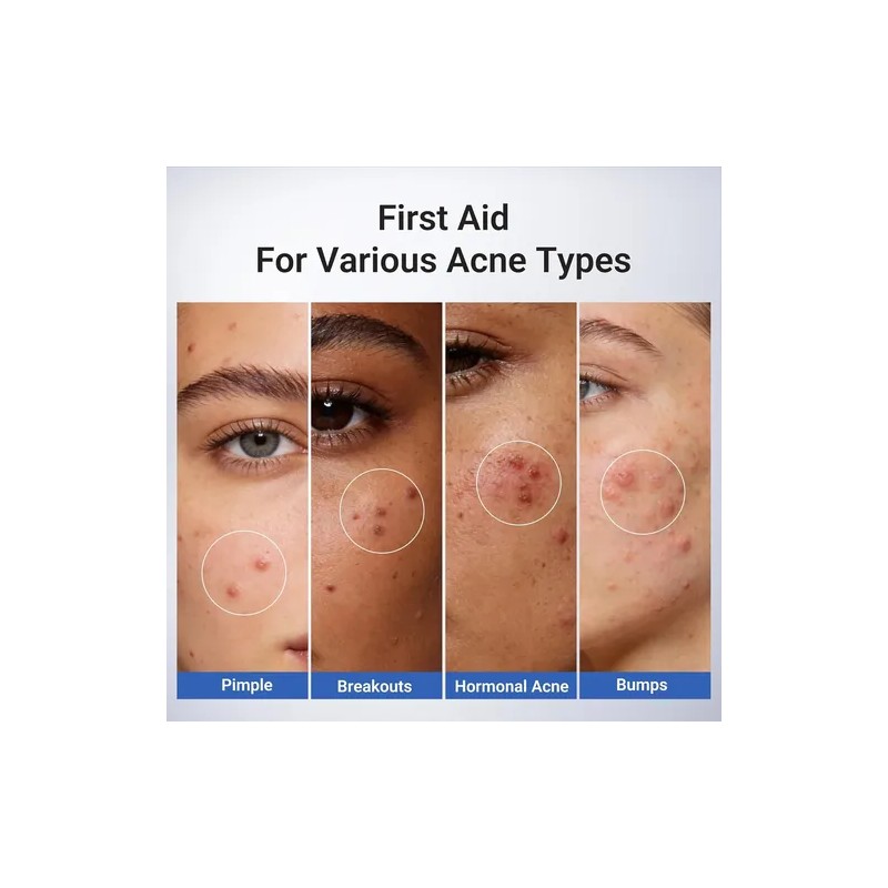 T; Loción Acne Buster, Ácido Salicílico Para El Acné Y