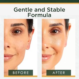 ToLB Vitamin C Serum for Face with Hyaluronic Acid - Anti Aging Anti Wrinkle Facial Serum with Natural Ingredients - Paraben Free, Vegan - Best Vitamin C with Hyaluronic Acid Serum for Skin - 1 fl oz