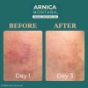 Gel De Árnica Para Cara, Crema De Árnica Y Crema