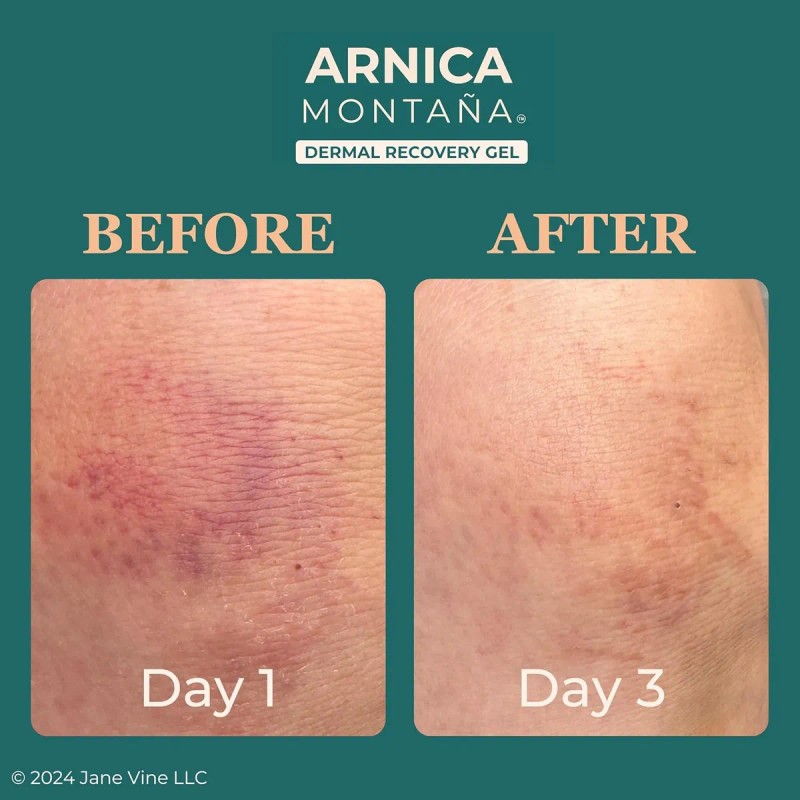 Gel De Árnica Para Cara, Crema De Árnica Y Crema