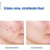 aknederm Creme H 2 x 30 g - Skin Tinted