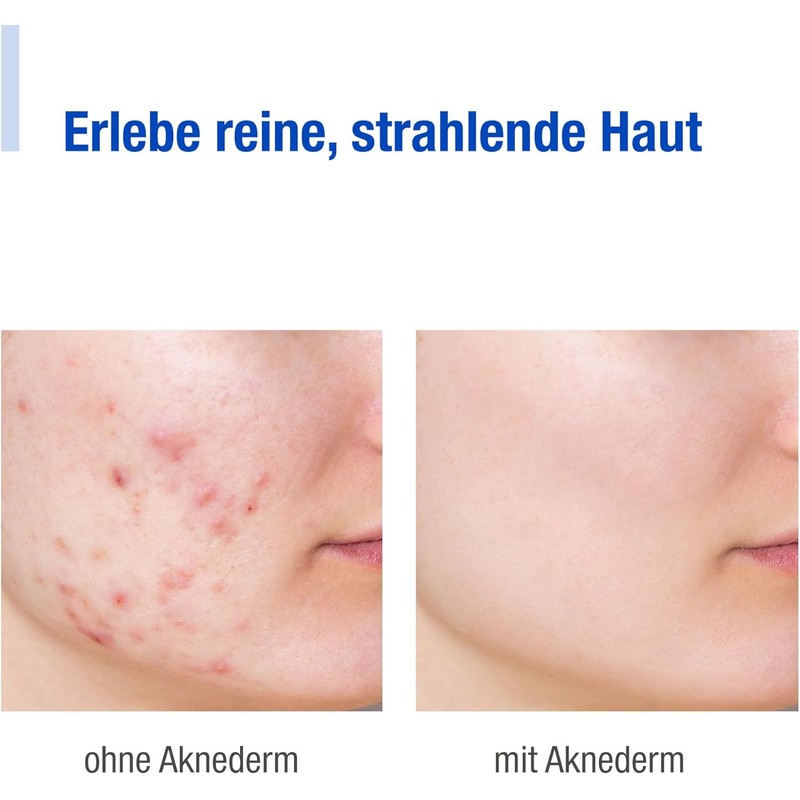 aknederm Creme H 2 x 30 g - Skin Tinted