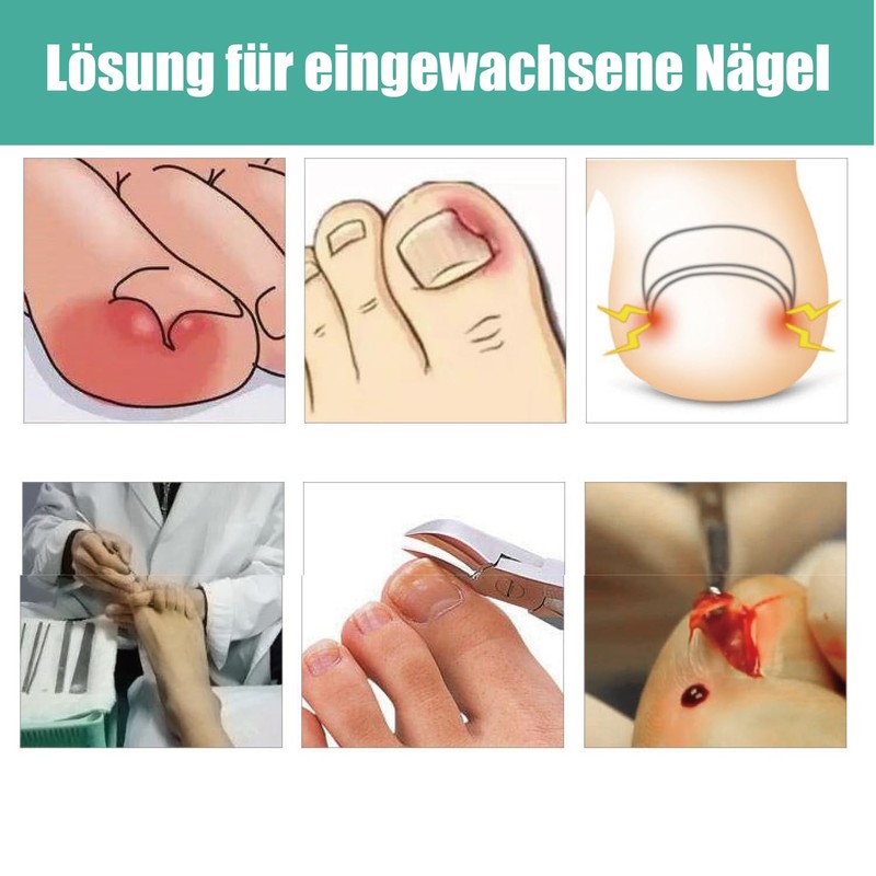 Esshogo 1 Set Ingrown Toenail Tools, Nail Correction Buckle, Patch