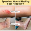 Manuka Honey for Wounds, Speed up Healing for Cuts, Surgical