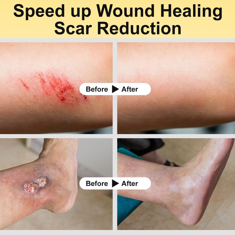 Manuka Honey for Wounds, Speed up Healing for Cuts, Surgical