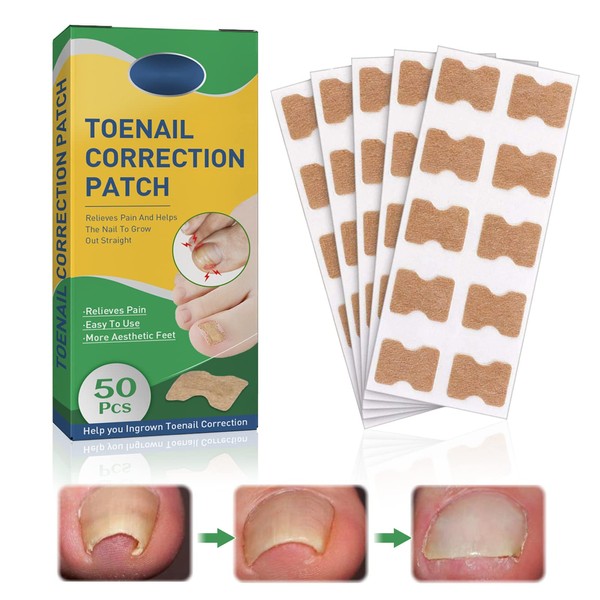 Toenail Patch 50Pcs, Ingrown Toenail Corrector Patch, Ingrown Toenail Patch for Ingrown Toe Nail Treatment and Ingrown Curved