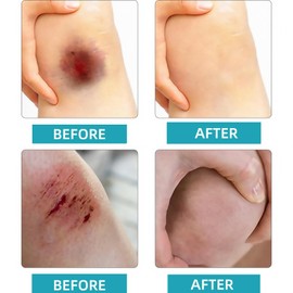 2Pcs Liquid Plaster Quick-Dry Gel,Skin Liquid Plaster Gel,Quick-Drying Dressing,Wound Liq/uid Ge/l,Transparent Waterproof G/el Wound Stick Protective,Suitable for Women use,Essential for Home Care