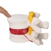 Human Herniated Disc Model, Anatomical Herniated Lumbar Vertebrae Disc Prolapse