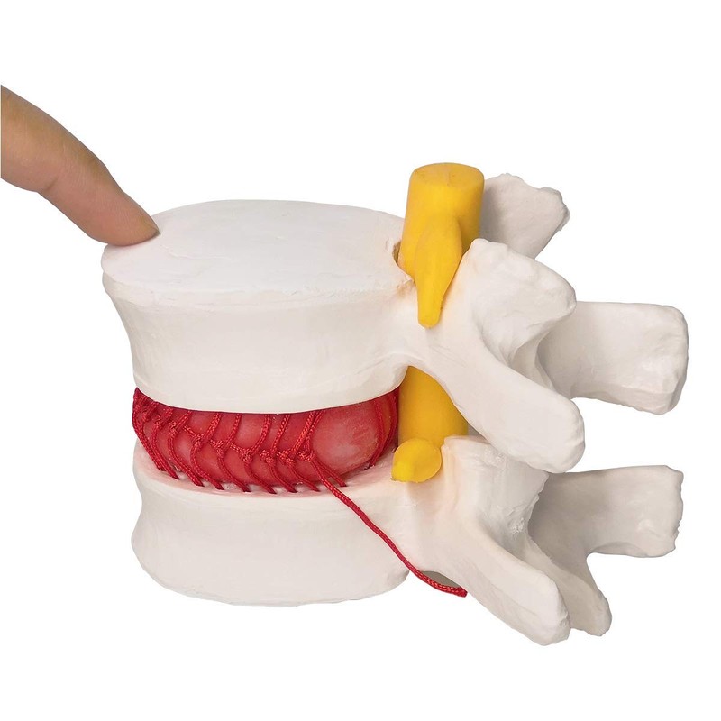 Human Herniated Disc Model, Anatomical Herniated Lumbar Vertebrae Disc Prolapse