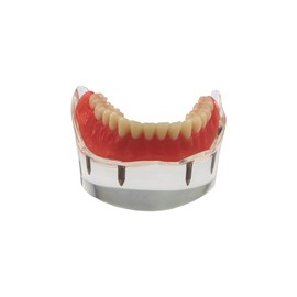 Dental Implant Teeth Demo Model Mandibular Overdenture with 4 Implants