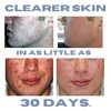 Clearogen Acne Treatment Kit, Acne Kit, Skin Care Acne, Acne