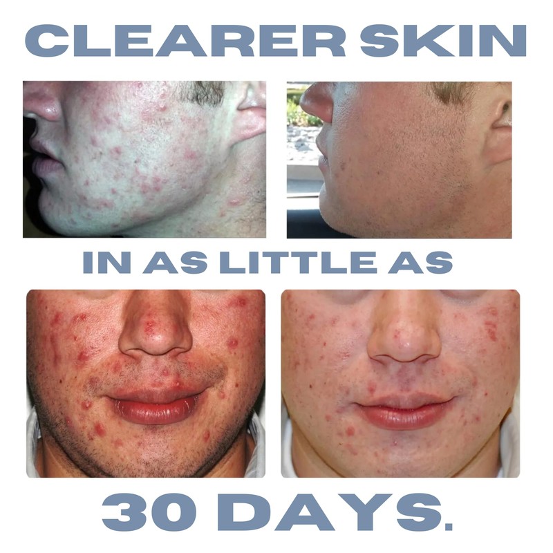 Clearogen Acne Treatment Kit, Acne Kit, Skin Care Acne, Acne