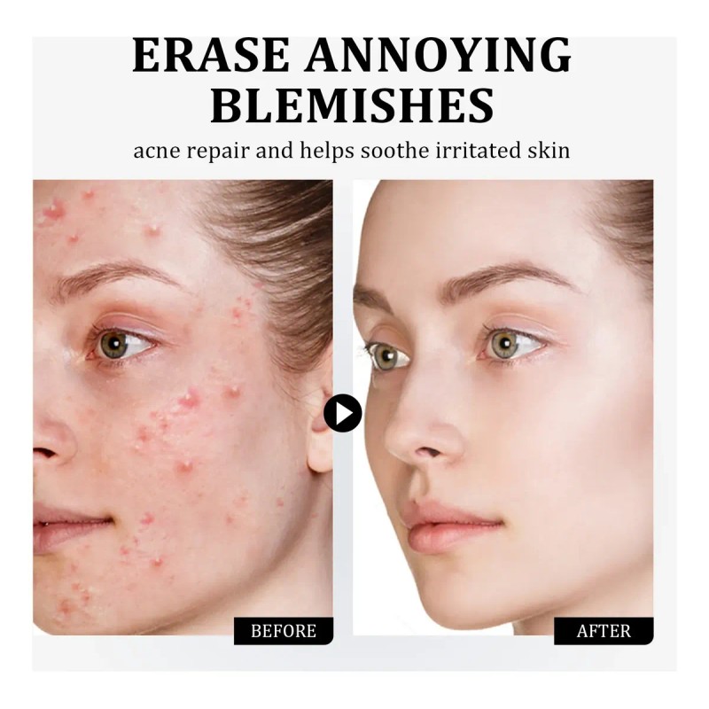 Crema Ácido Azelaico Niacinamida Vitamina