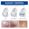 Líquida De Eliminación De Verrugas Y Mezquinos 30ml