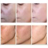 Crema blanqueadora eliminadora de melanina, melasma y pecas