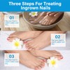 Ingrown Toenail Treatment Drops - Plant-Based Softener Solution